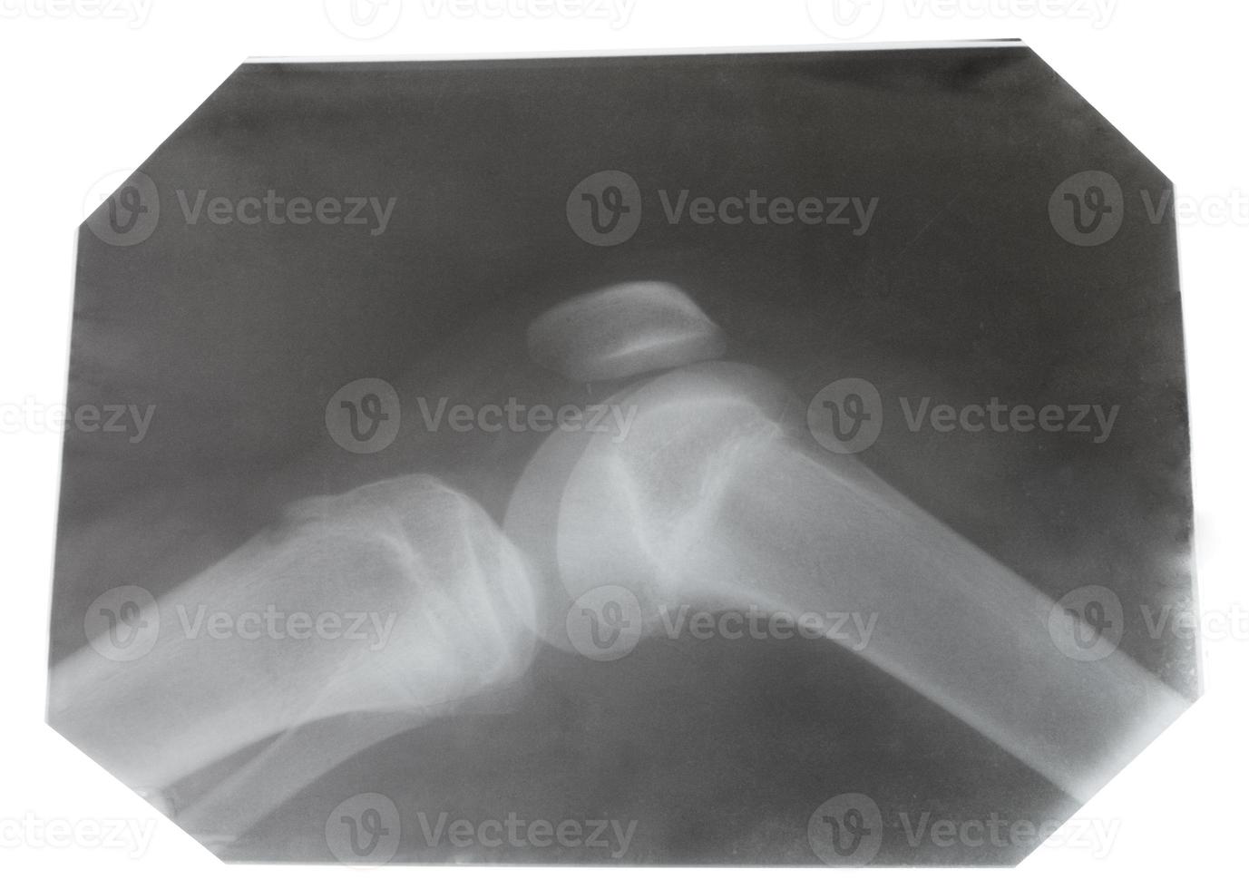 raggi X immagine di umano ginocchio comune foto