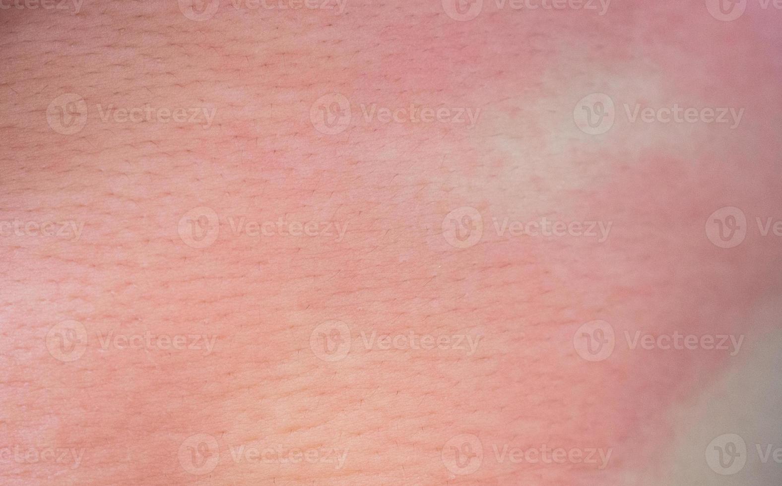 acuto eczema pelle eruzione cutanea e allergico reazione sintomo a poco asiatico bambino corpo causa di ipersensibilità foto