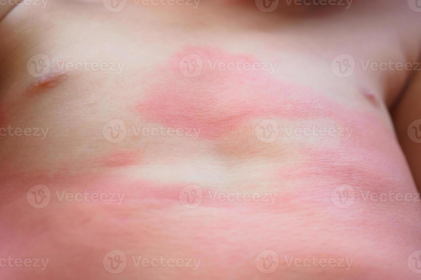 acuto eczema pelle eruzione cutanea e allergico reazione sintomo a poco asiatico bambino corpo causa di ipersensibilità foto