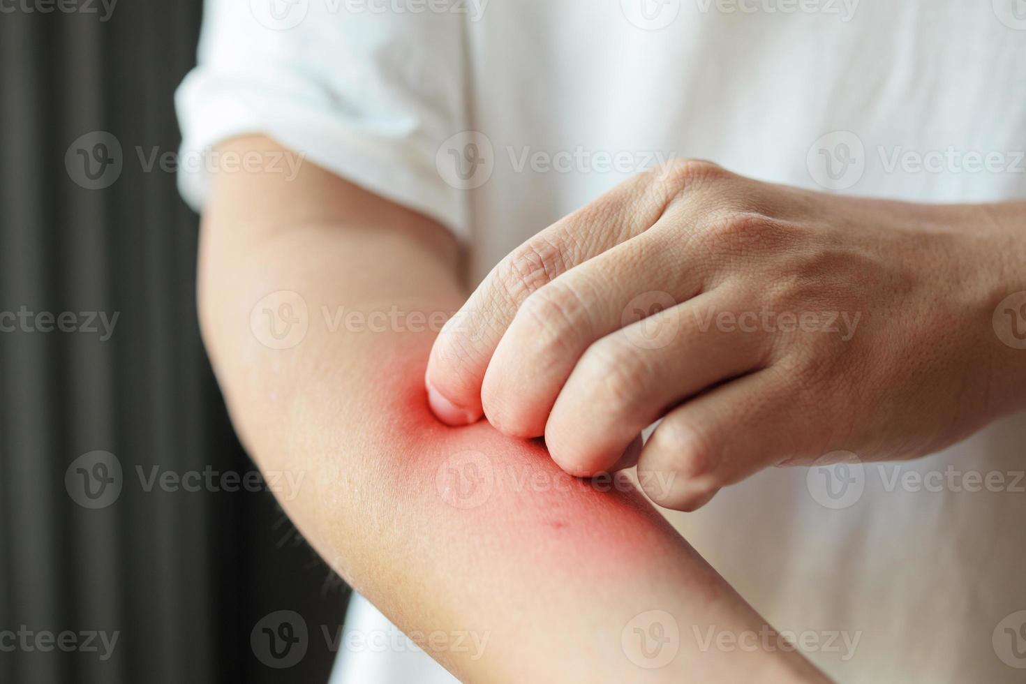 uomo pizzicore e graffiare su braccio a partire dal insetto mordere o prurito asciutto pelle eczema dermatite foto