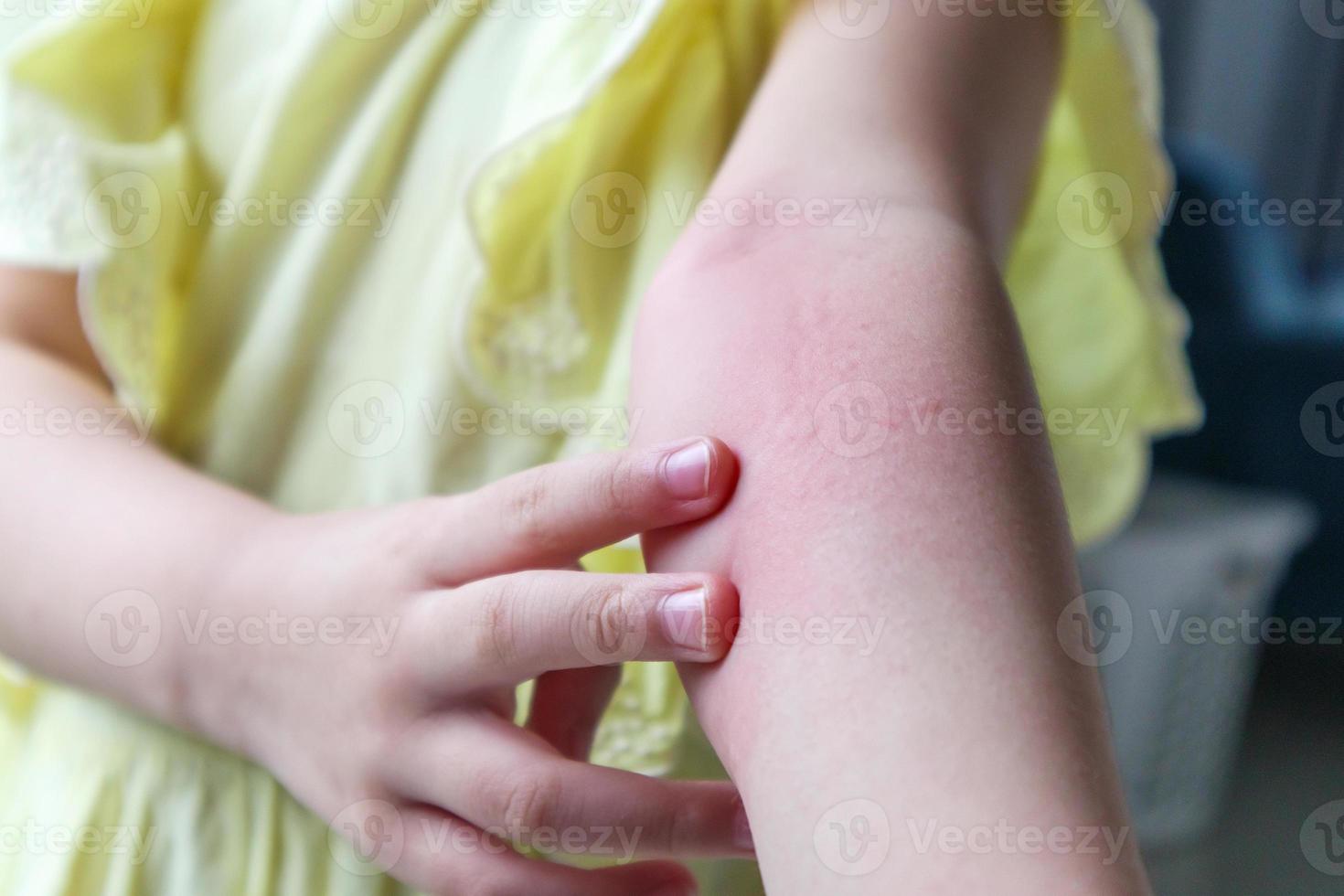 poco ragazza ha pelle eruzione cutanea allergia e prurito su sua braccio foto
