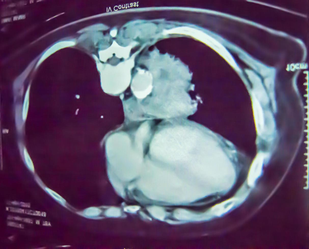 sfocato con rumore di un' ct scansione film di polmone cancro nel nero. foto