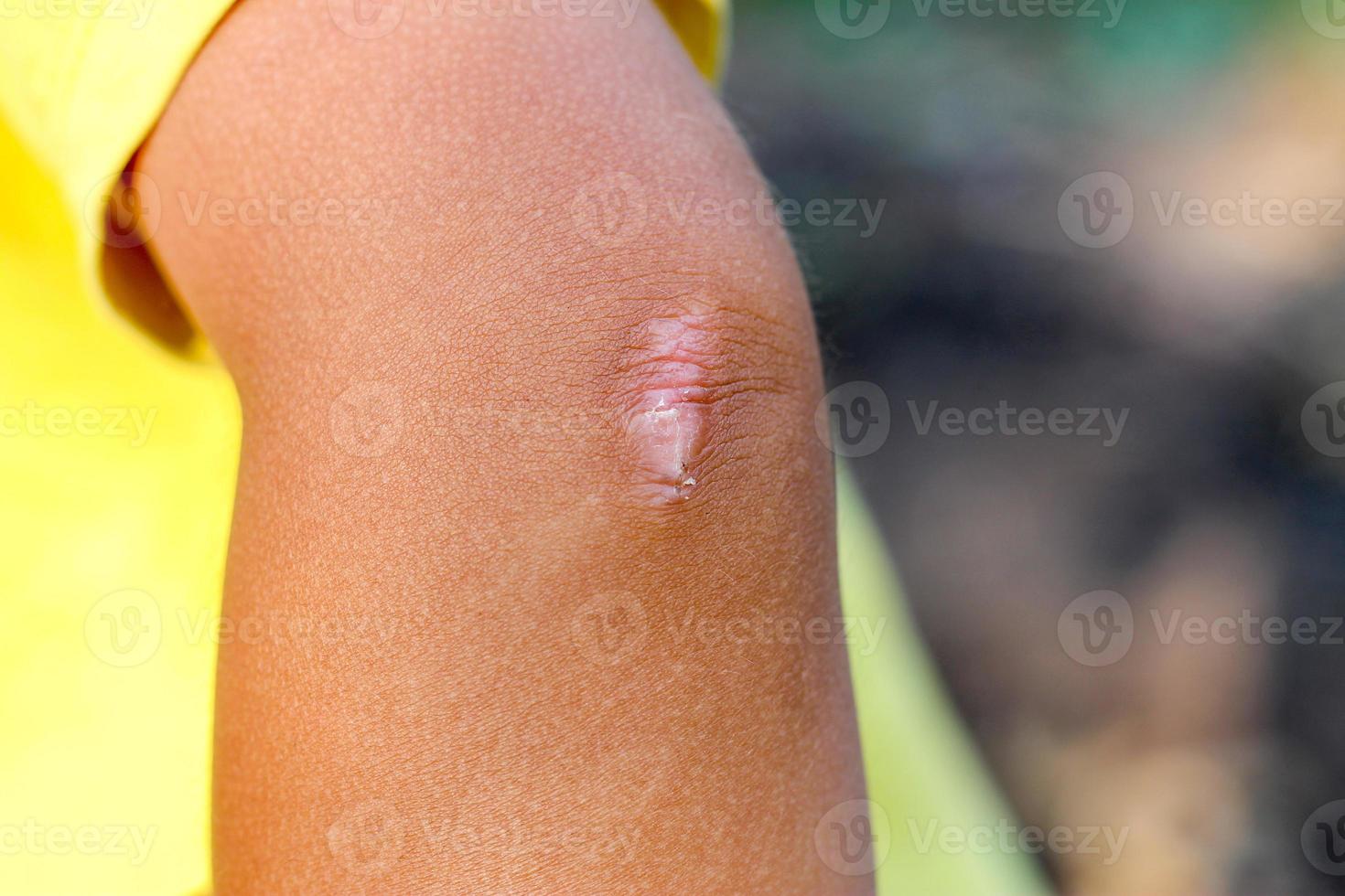 cicatrice su il gomito di il bambino. foto