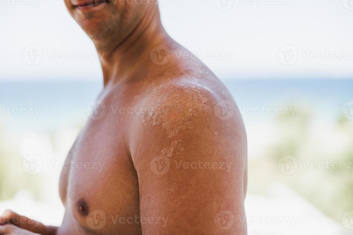 vicino su di un' rosso spalla e indietro di un' uomo con un' bruciato dal sole pelle foto