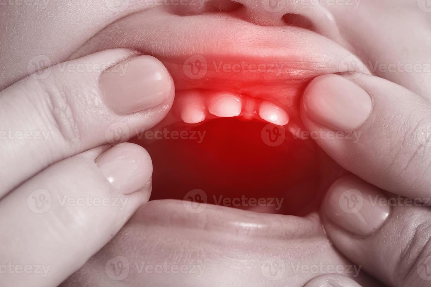 bambino sofferenza a partire dal doloroso dentizione sintomi foto