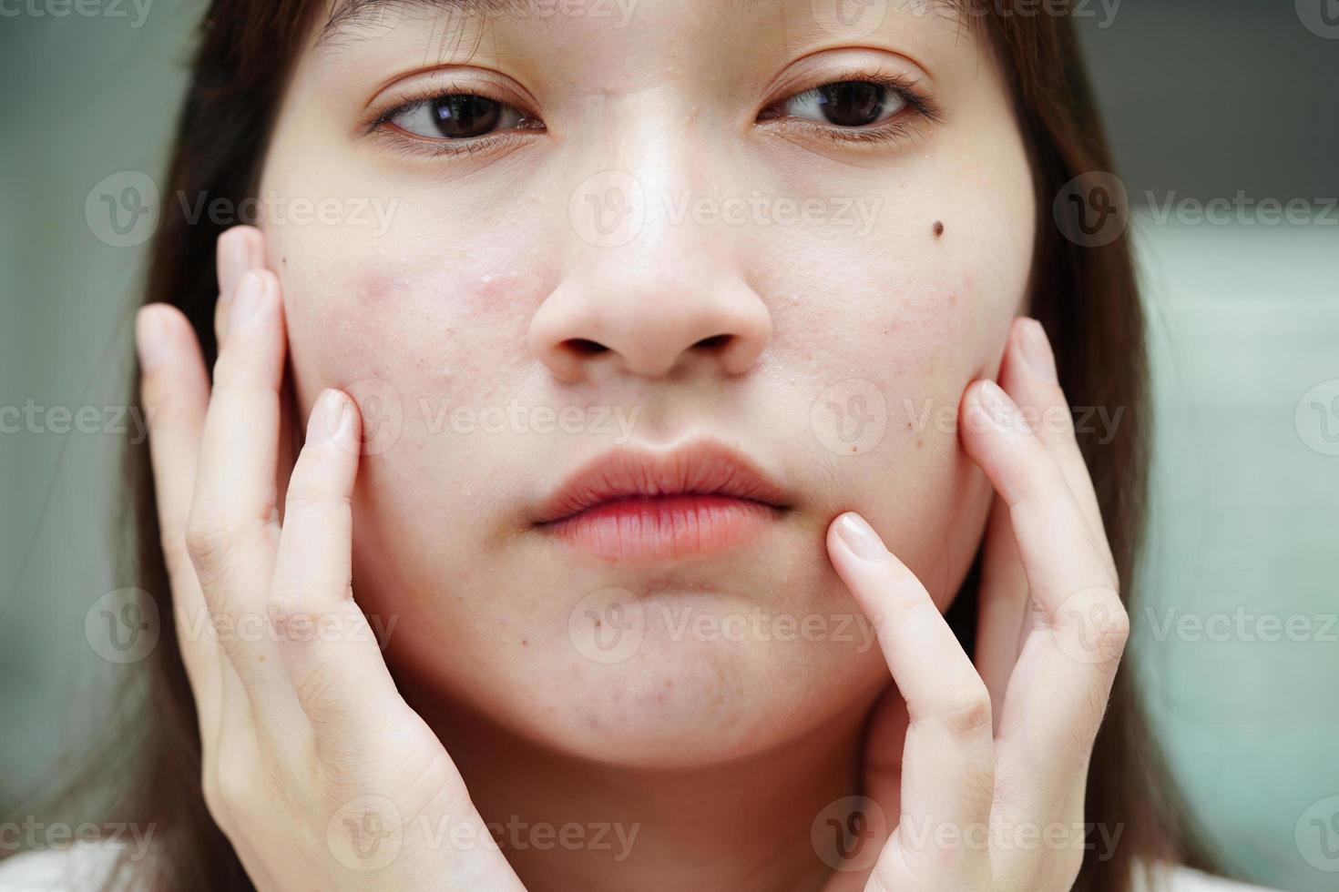 acne brufolo e cicatrice sulla pelle del viso, disturbi delle ghiandole sebacee, problema di bellezza per la cura della pelle delle ragazze adolescenti. foto