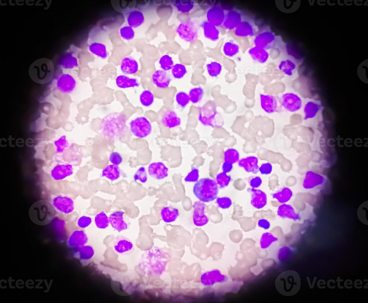 sangue sbavatura sotto microscopia mostrando cronico linfoblastico leucemia o cll foto