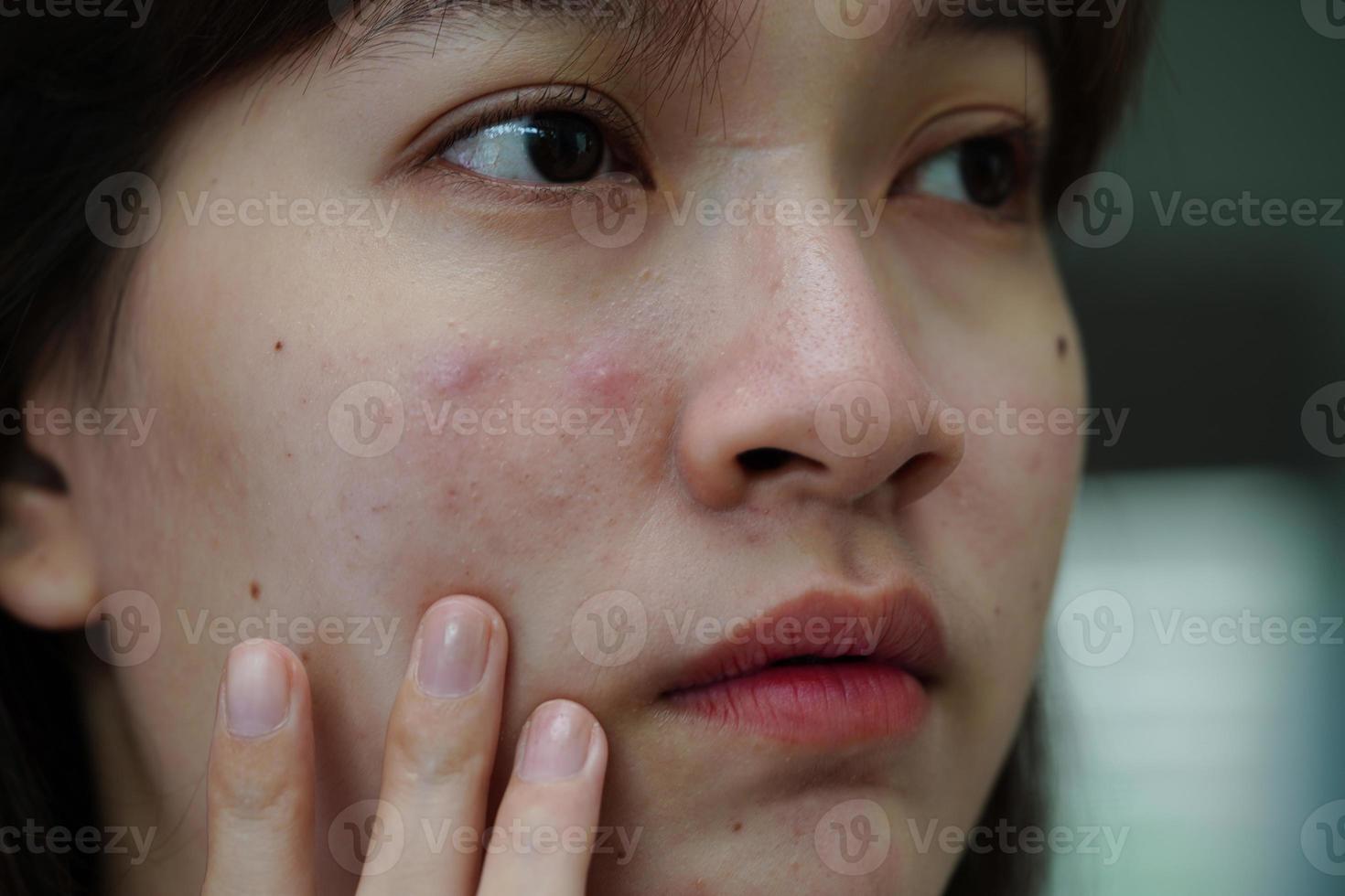 acne brufolo e cicatrice sulla pelle del viso, disturbi delle ghiandole sebacee, problema di bellezza per la cura della pelle delle ragazze adolescenti. foto