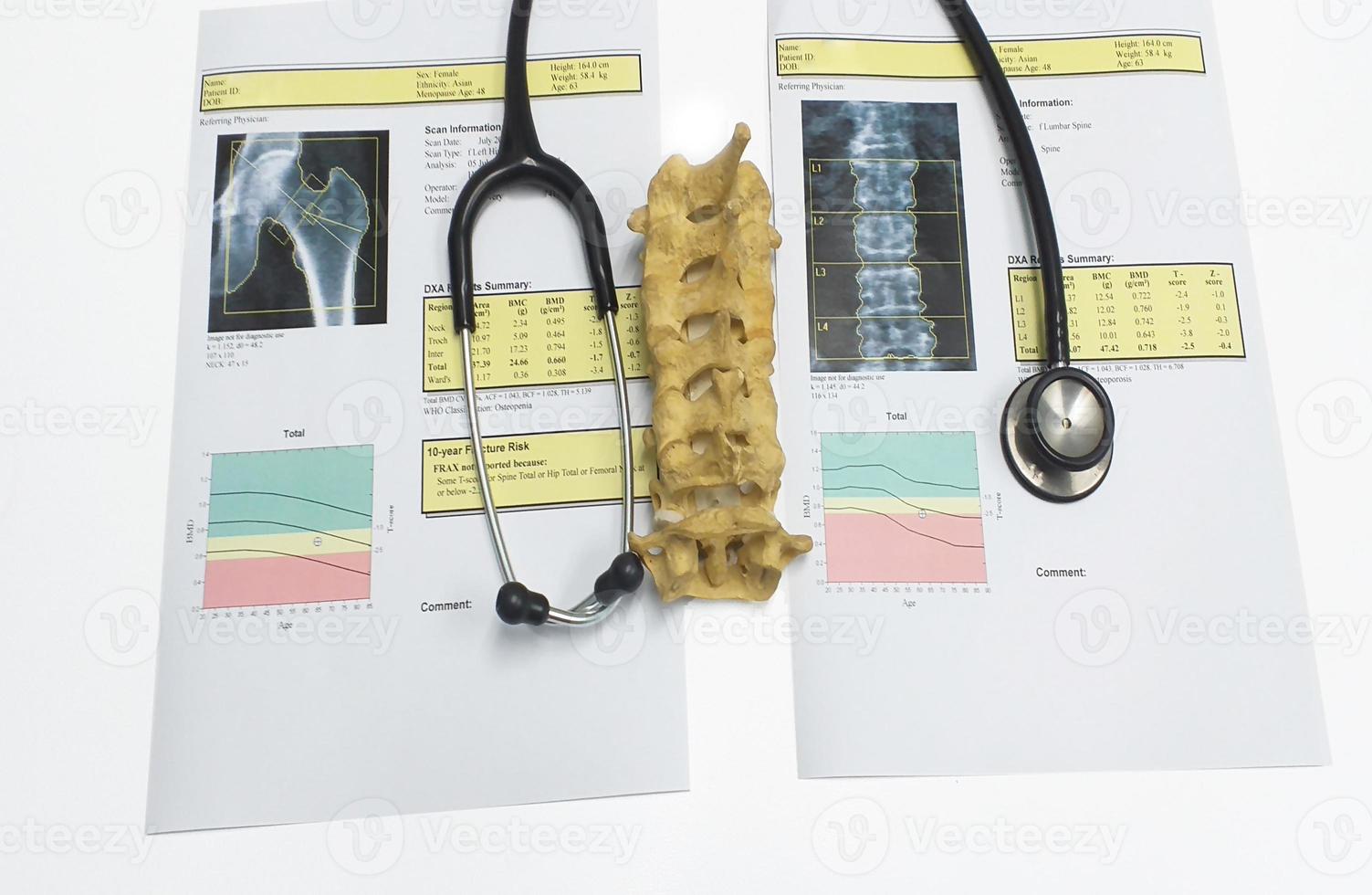 osso densità anca e zona lombare risultato osteoporosi foto