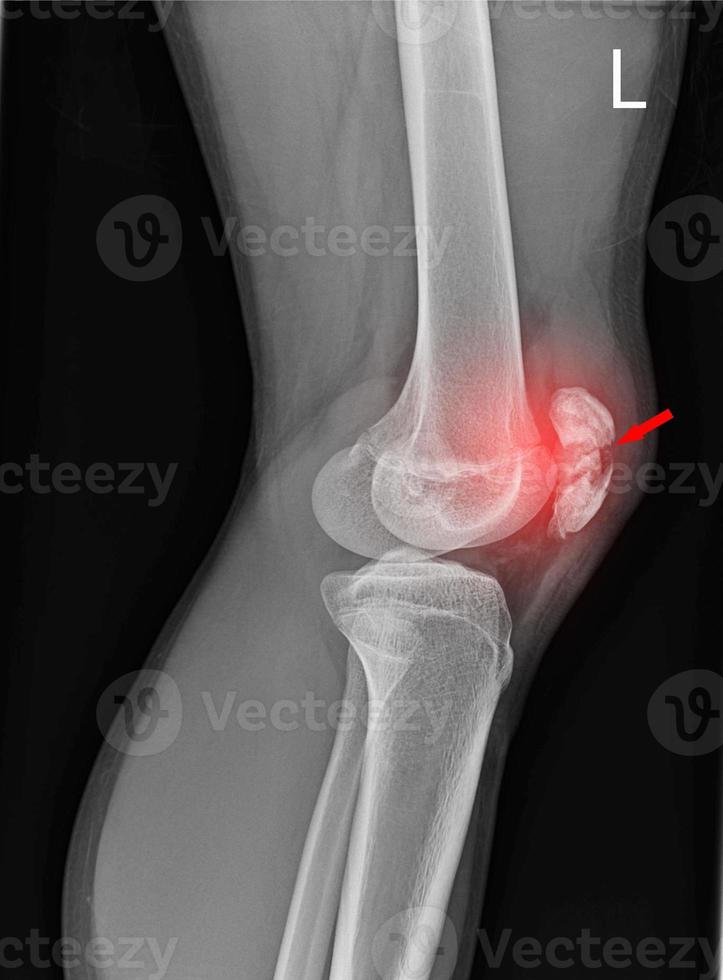 un' film raggi X di sinistra ginocchio laterale Visualizza mostrato frattura di ginocchio berretto patella osso foto