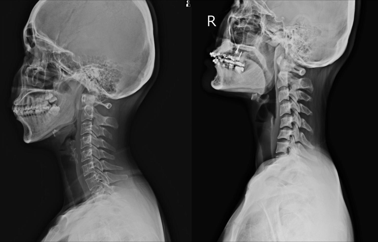 raggi X cervicale colonna vertebrale foto