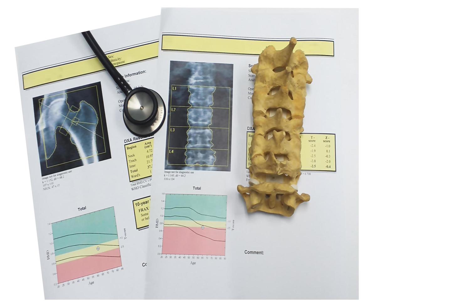 osso densità anca e zona lombare risultato osteoporosi foto