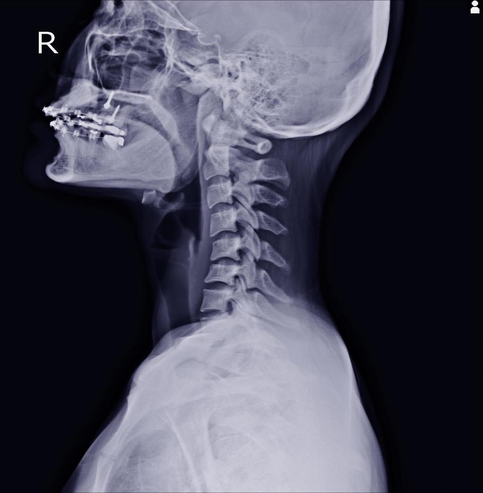 raggi X cervicale colonna vertebrale foto