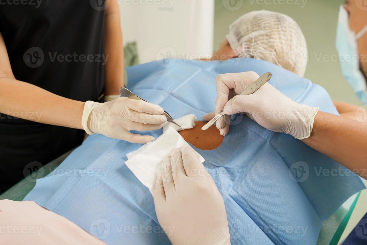 medico e infermiera durante voglia rimozione dermatologico chirurgia foto