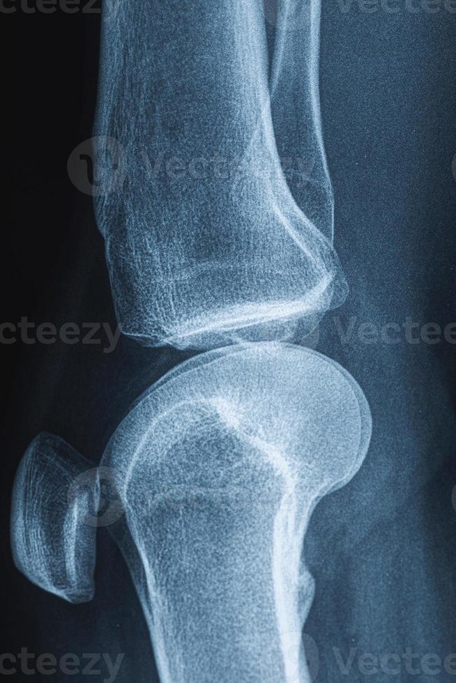 raggi X Immagine di umano ginocchio foto
