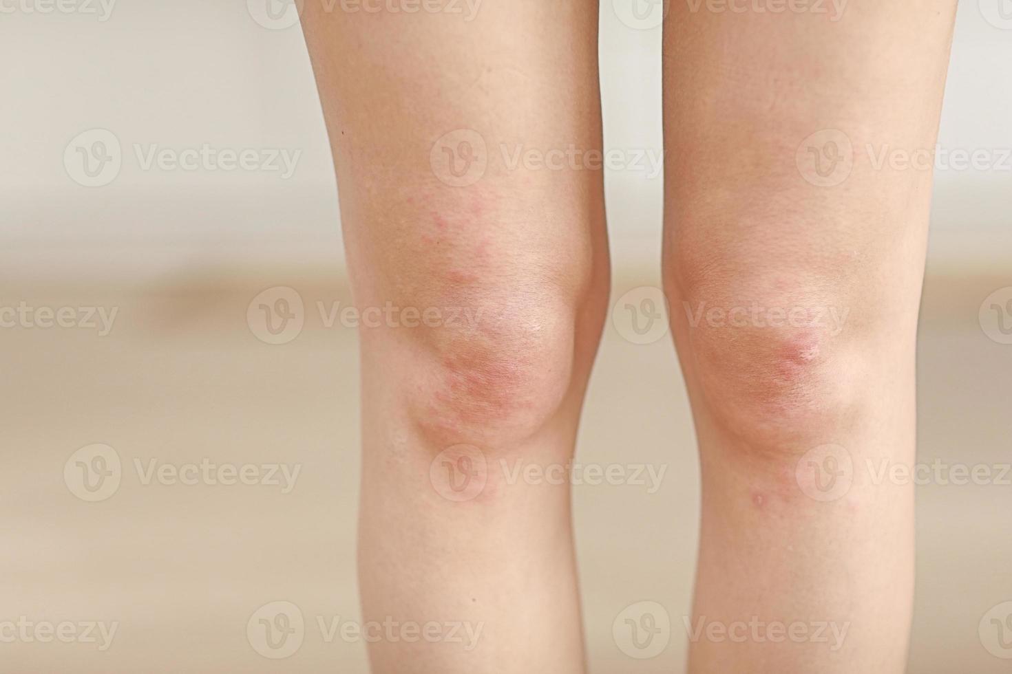 allergie cutanee, donne con la pelle delle gambe. primo piano di pustole rosse su un ginocchio, una reazione allergica causata dalla dermatite atopica. messa a fuoco selezionata foto