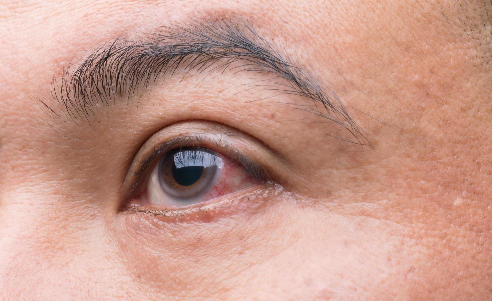 occhio irritazione concetto rosso occhio di uomo, congiuntivite occhio o dopo ottenere polvere foto