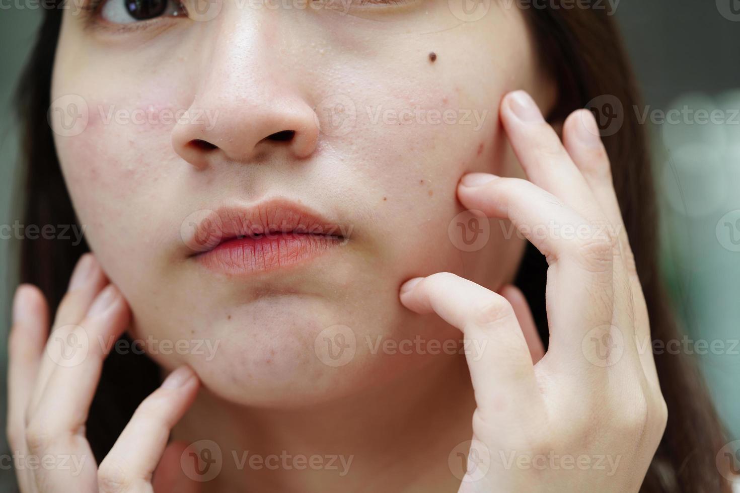 acne brufolo e cicatrice sulla pelle del viso, disturbi delle ghiandole sebacee, problema di bellezza per la cura della pelle delle ragazze adolescenti. foto