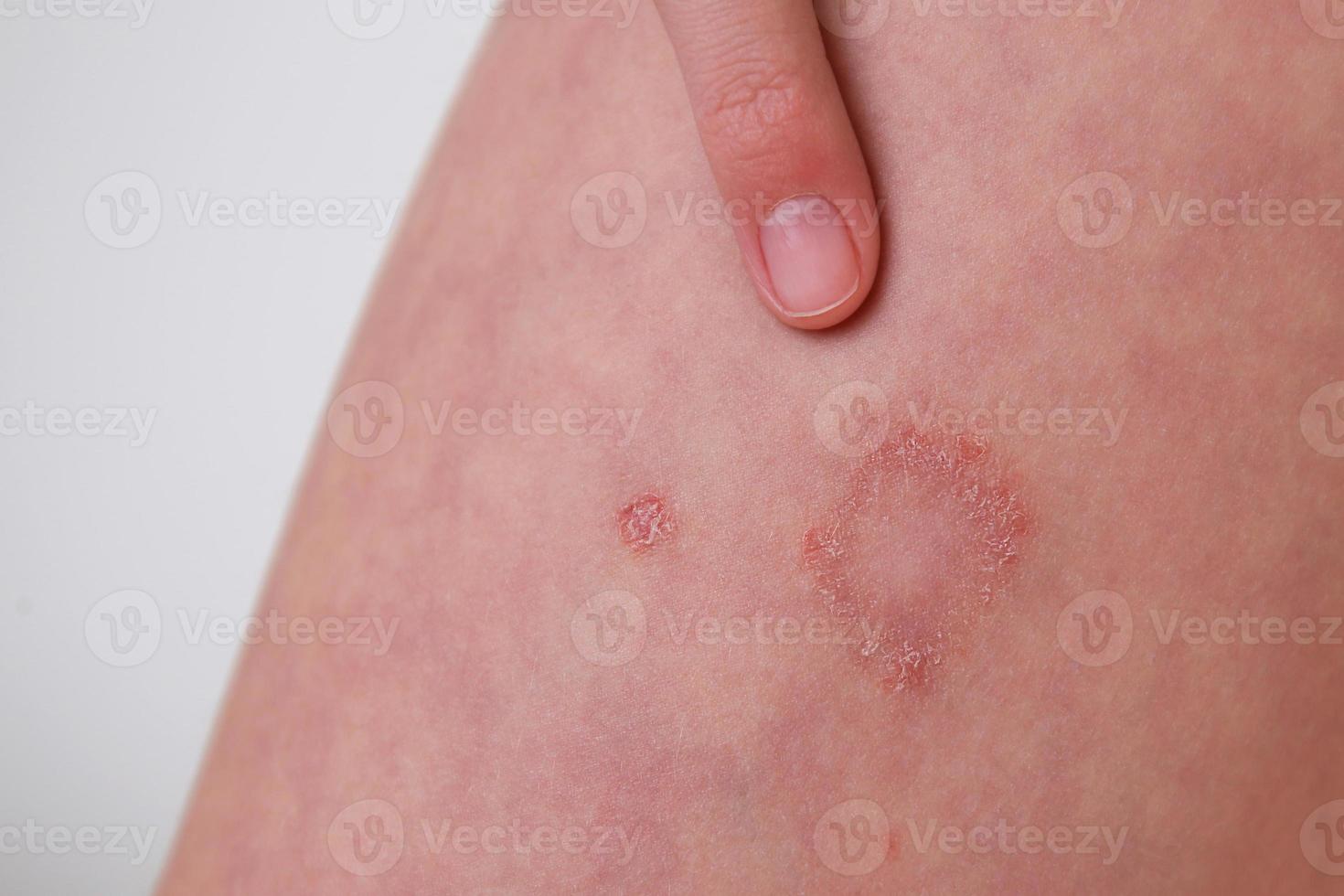 il bambino ha allergico contatto dermatite su il pelle. foto