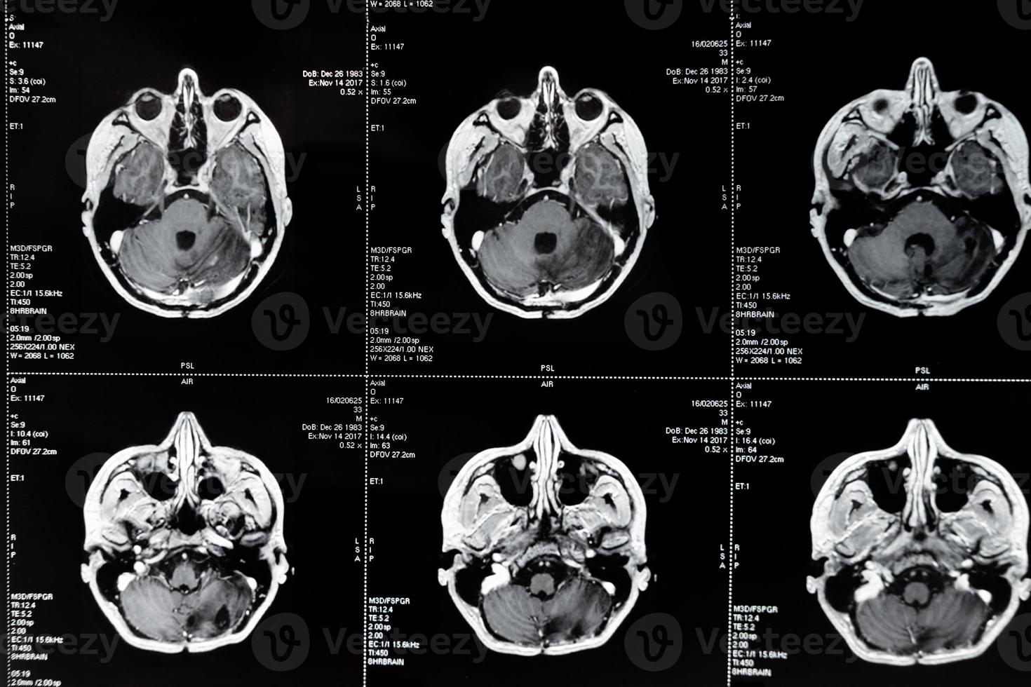 mri con cervello tumore. magnetico risonanza imaging. foto
