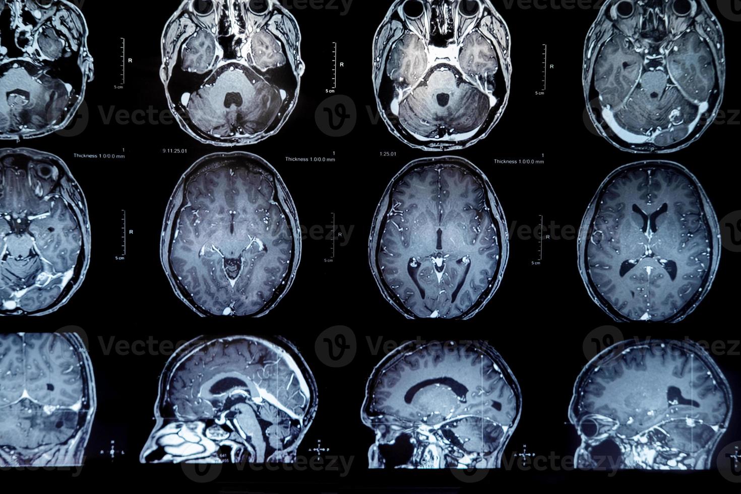 mri con cervello tumore. magnetico risonanza imaging. foto