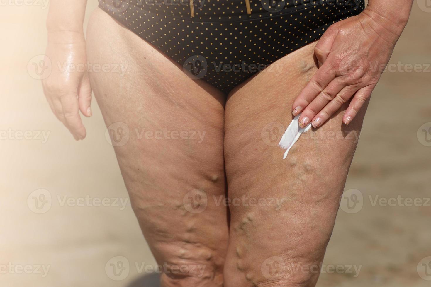 sovrappeso donna l'applicazione protezione solare lozione su sua gambe con varicose vene, vicino su dettaglio. vacanza su mare spiaggia. foto