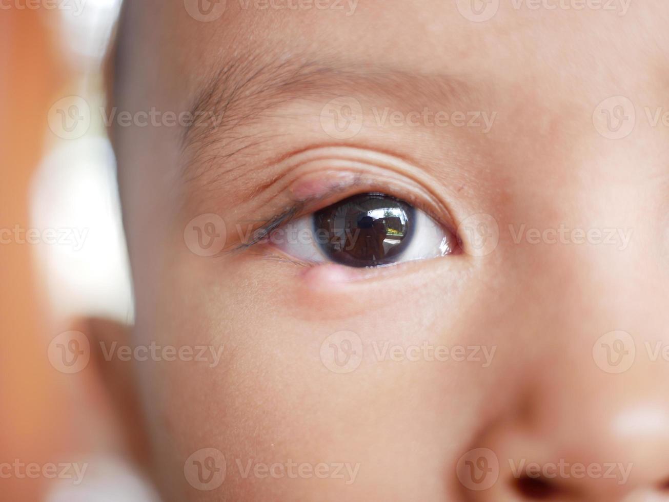 avvicinamento di infetto bambino occhio toppa con doloroso urto su inferiore palpebra. occhio malattia foto