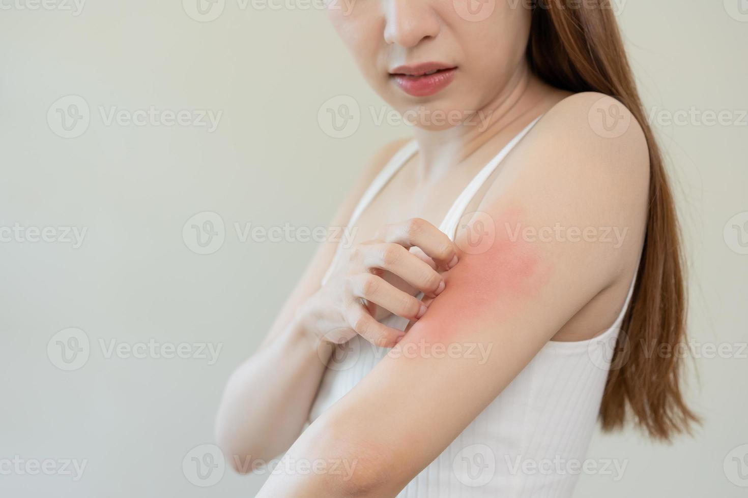 dermatologia, asiatico giovane donna, ragazza allergia, allergico reazione a partire dal atopico, insetto morsi su sua braccio, mano nel graffiare prurito, prurito rosso individuare o eruzione cutanea di pelle. assistenza sanitaria, trattamento di bellezza. foto