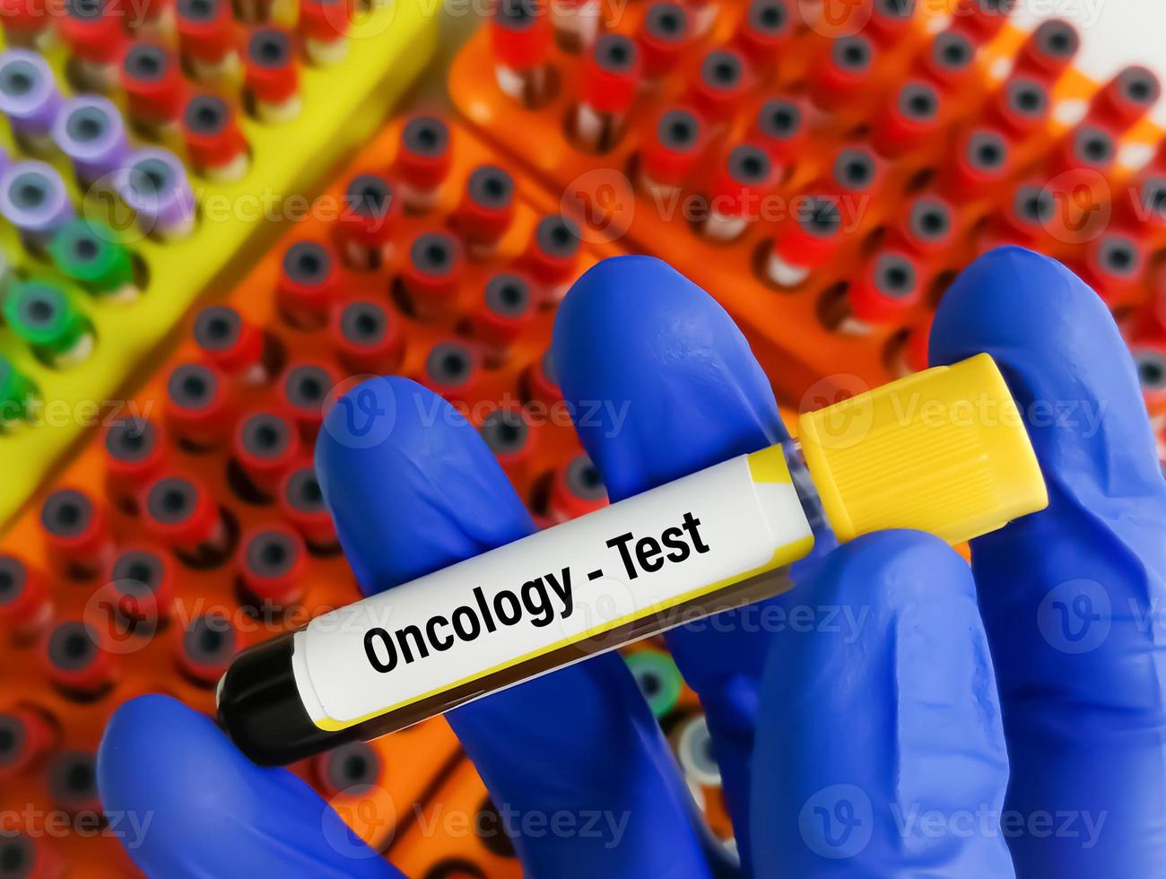 sangue campione per oncologia test, cancro. test tubo con un' sangue test nel il medico mani. medico concetto. foto
