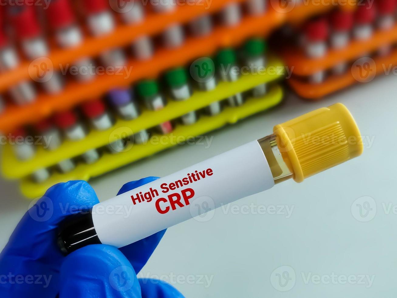 sangue campione tubo per hs-crp o alto sensibile crp test, per il diagnosi di infiammatorio cuore malattia foto