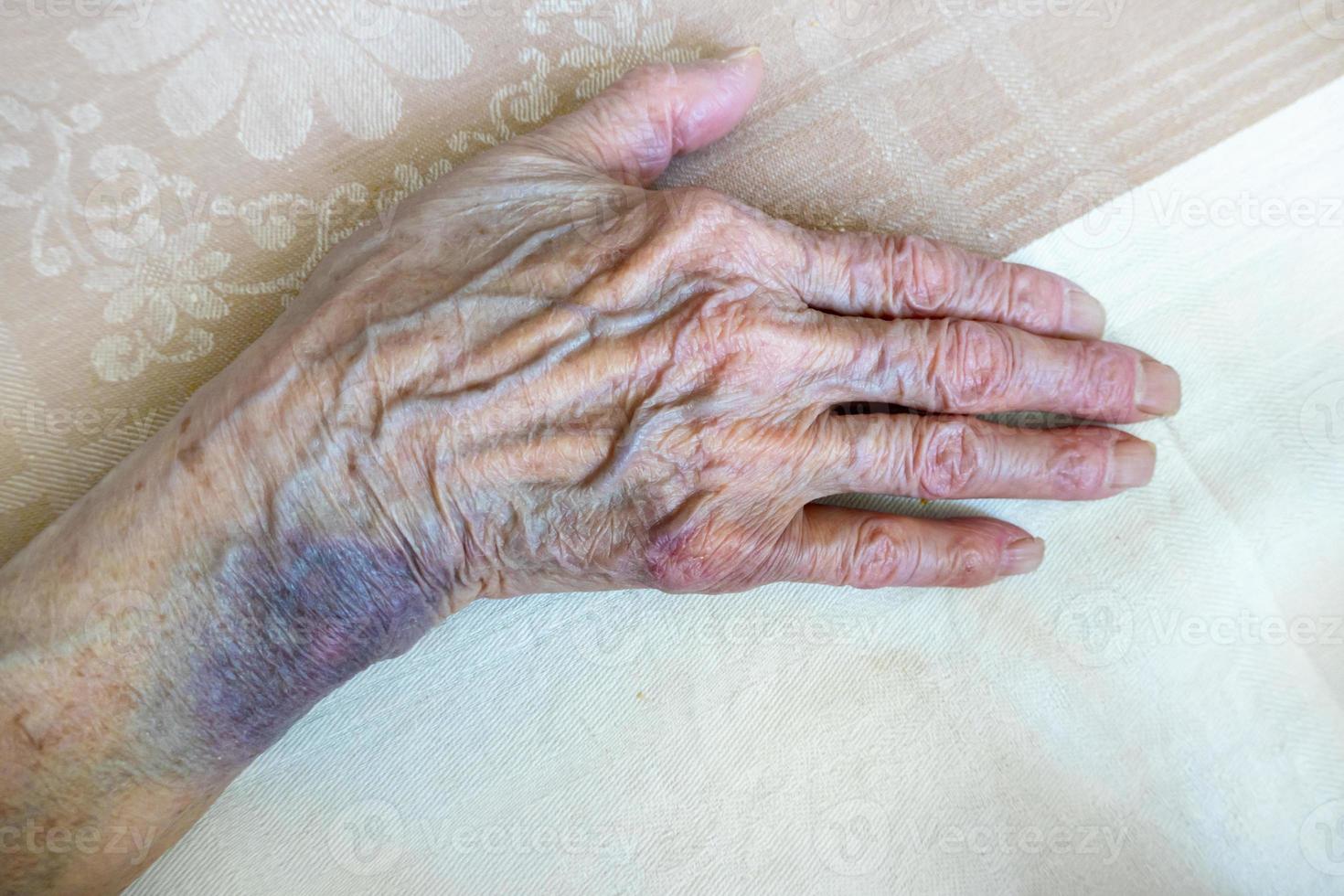 il mano di un anziano donna con lividi foto