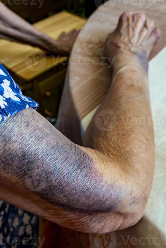 il mano di un anziano donna con lividi foto