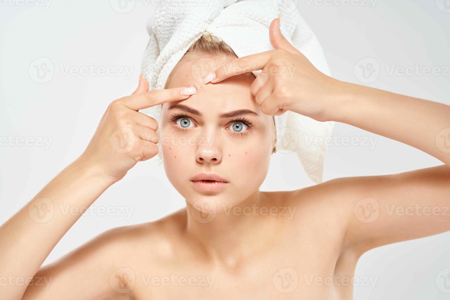 donna con spoglio le spalle acne su viso Salute avvicinamento ematologia foto
