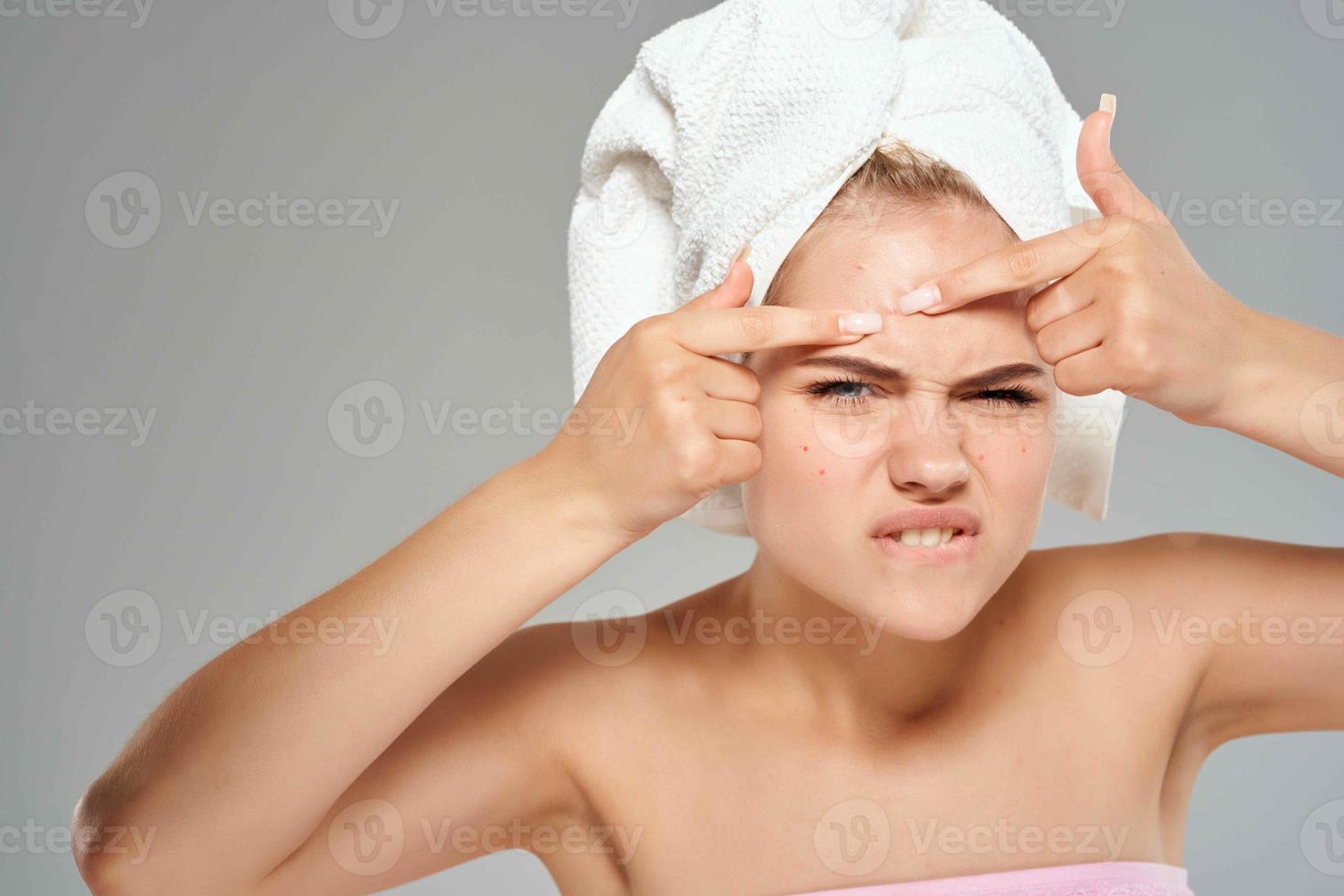 donna con un' asciugamano su sua testa acne su sua viso dermatologia pelle cura foto