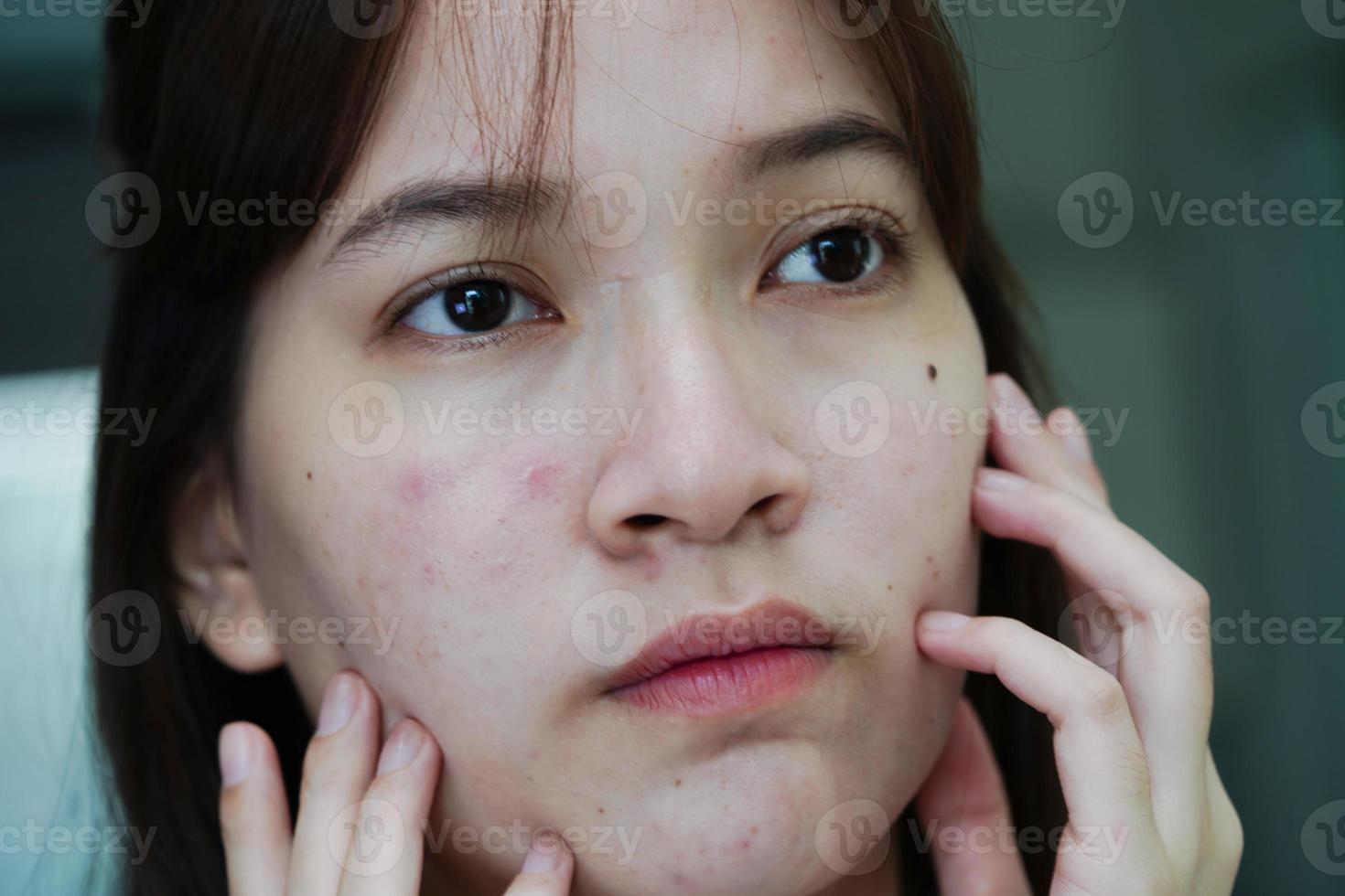 acne brufolo e cicatrice sulla pelle del viso, disturbi delle ghiandole sebacee, problema di bellezza per la cura della pelle delle ragazze adolescenti. foto