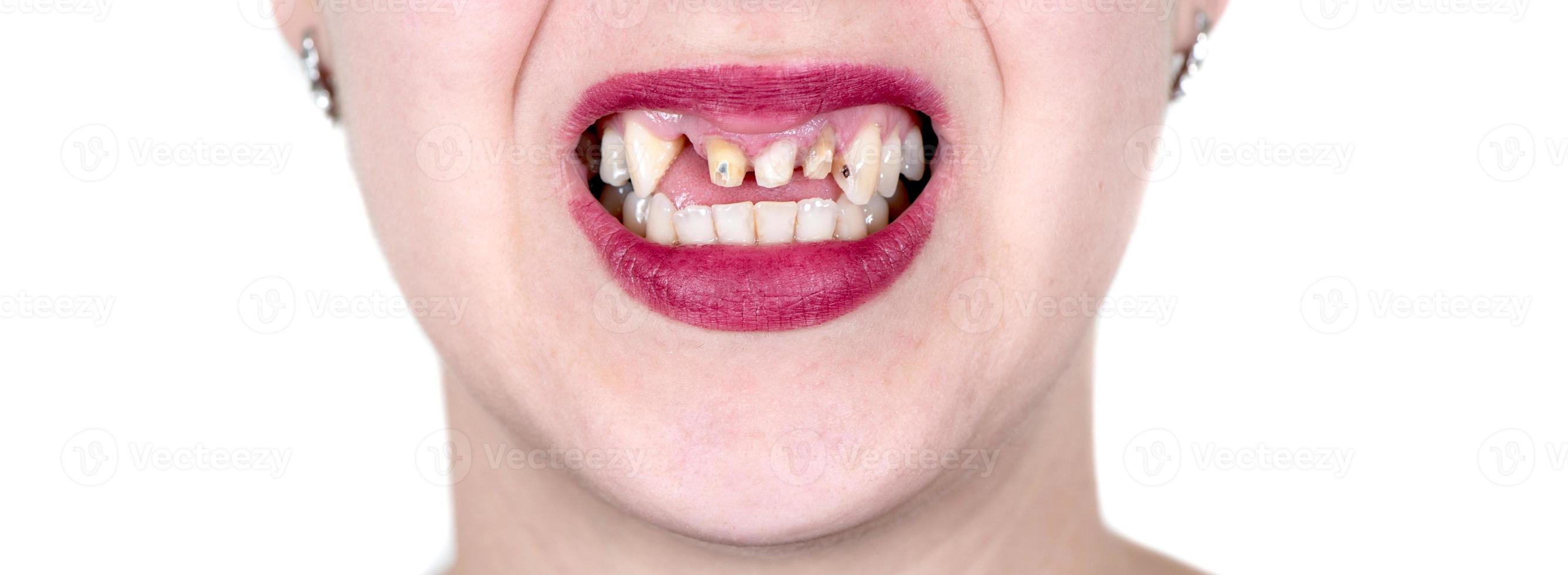 Sorridi di donna senza davanti denti foto