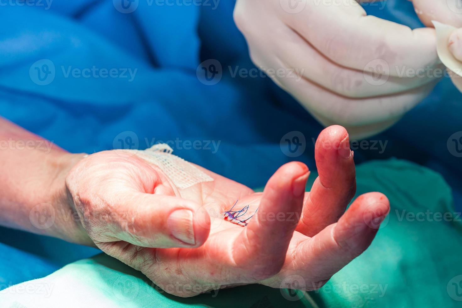 chirurgo bendaggio il mano di un' paziente a il fine di chirurgia foto