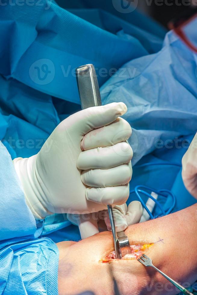 gruppo di chirurghi l'esecuzione un gomito chirurgia foto