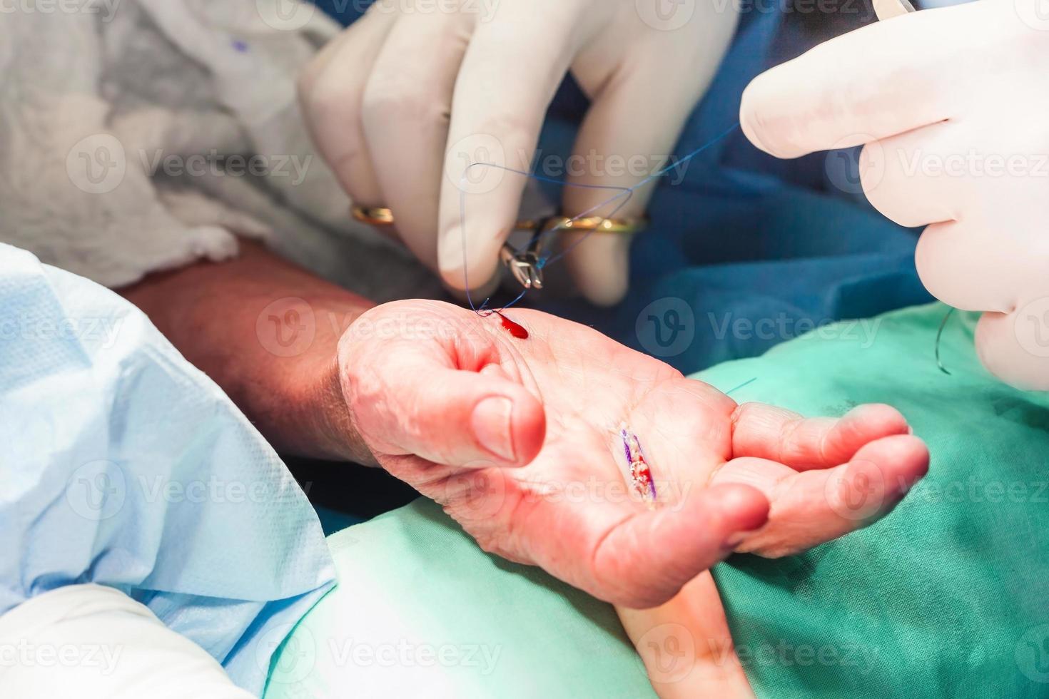 chirurgo sutura il mano di un' paziente a il fine di chirurgia foto