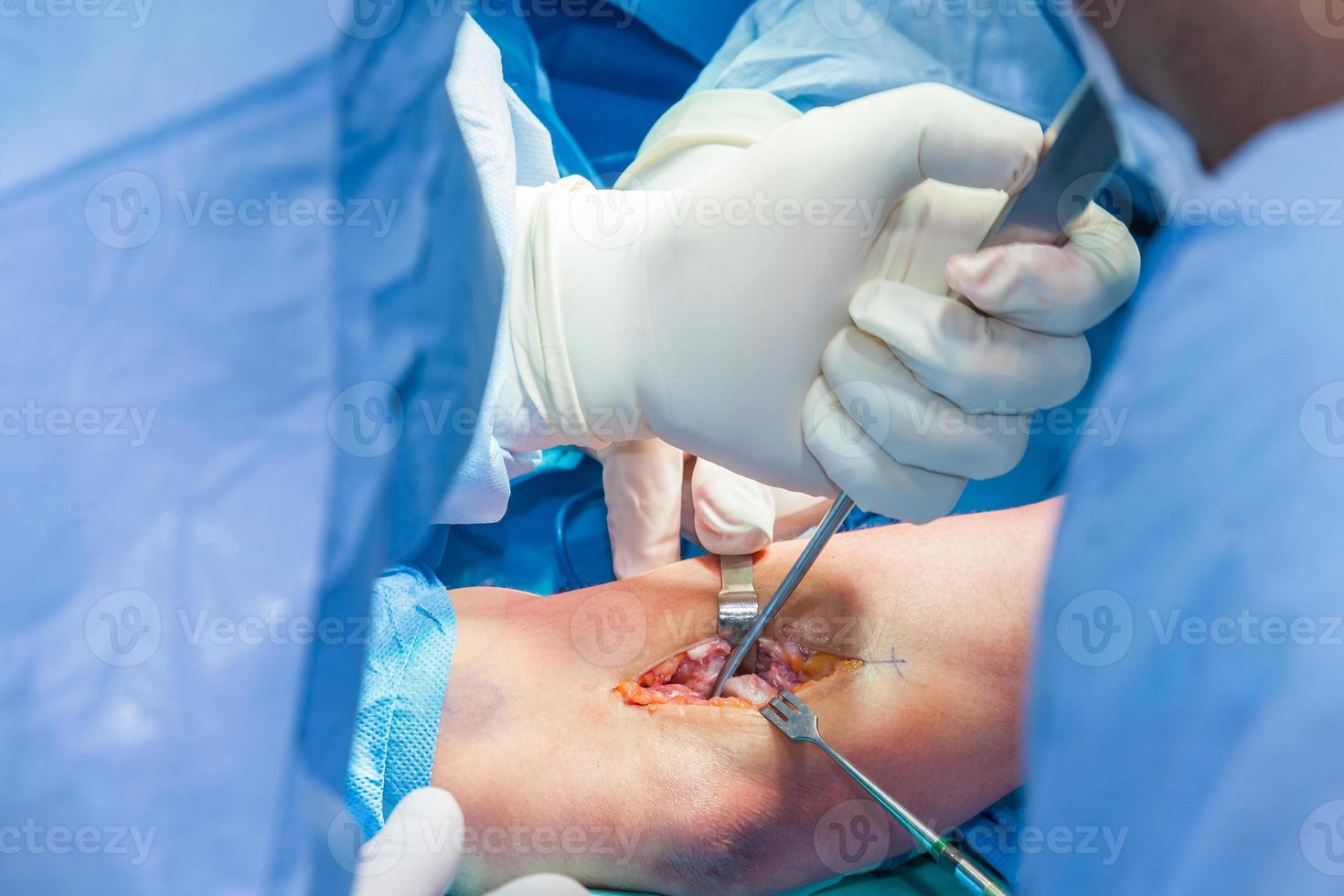 gruppo di ortopedico chirurghi l'esecuzione chirurgia su un' paziente braccio foto