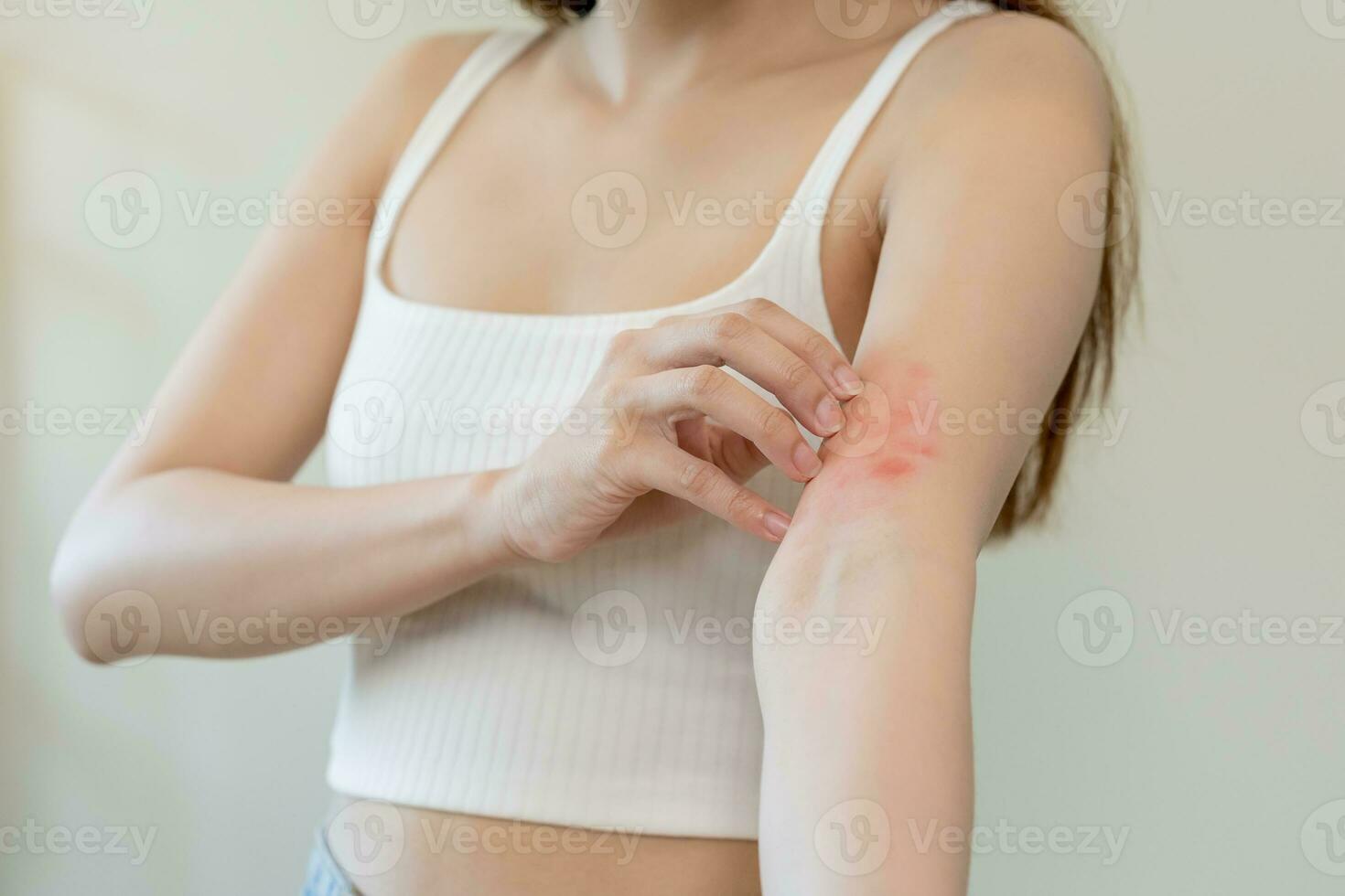 dermatologia asiatico giovane donna, ragazza allergia, allergico reazione a partire dal atopico, insetto morsi su sua braccio, mano nel graffiare prurito, prurito rosso individuare o eruzione cutanea di pelle. assistenza sanitaria, trattamento di bellezza. foto