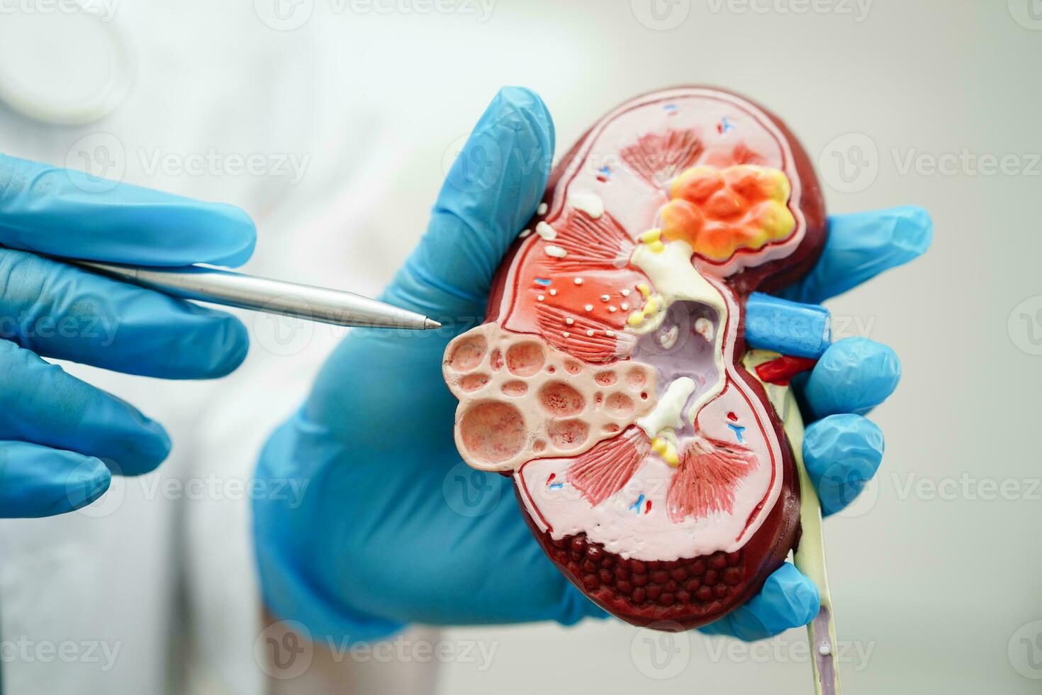 cronico rene patologia, medico Tenere modello per trattamento urinario sistema, urologia, stimato glomerulare filtrazione Vota egfr. foto