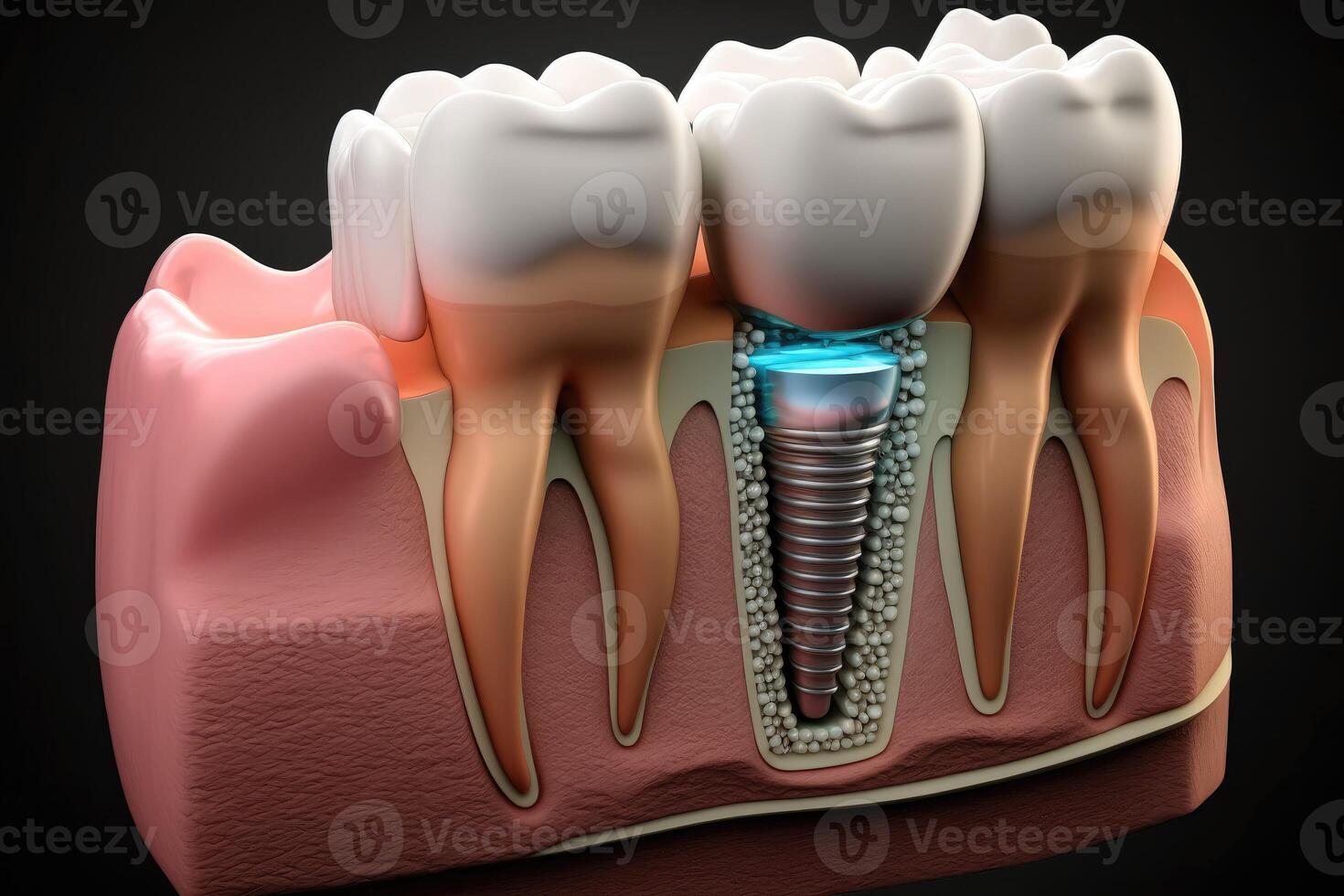 ai generato concetto per dentale protesi. dimostrando il posizionamento di un' dentale impiantare. vicino su modello di dei denti anatomia. foto