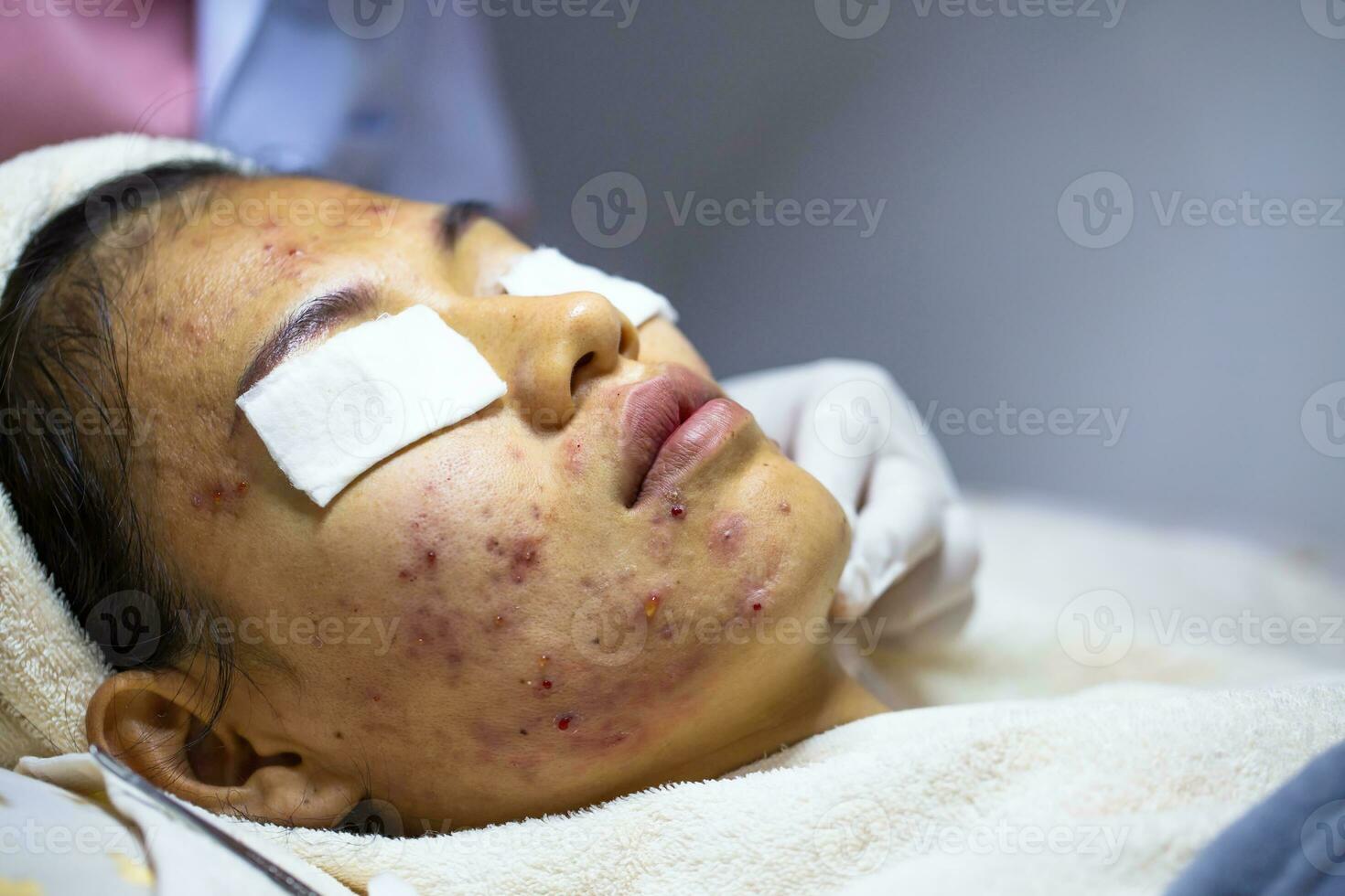 giovane donna urgente brufoli a il clinica. i problemi quello donne preoccupazione di pelle infiammazione. bellezza nel donne. foto