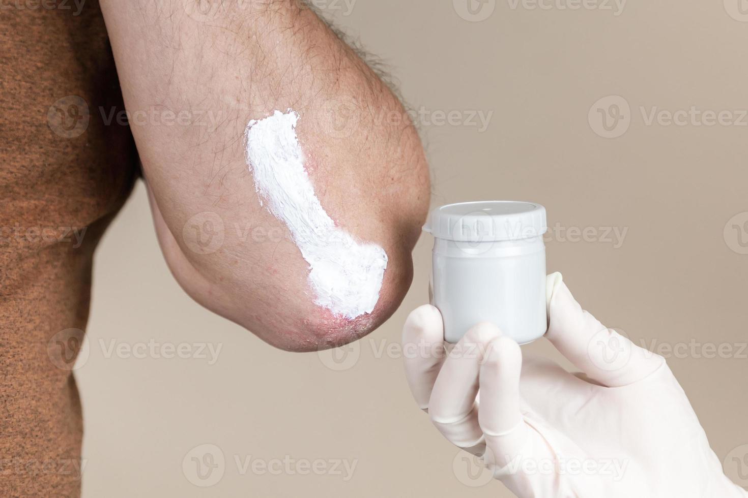 un dermatologo in guanti applica un unguento terapeutico sulla pelle colpita di un paziente con psoriasi foto