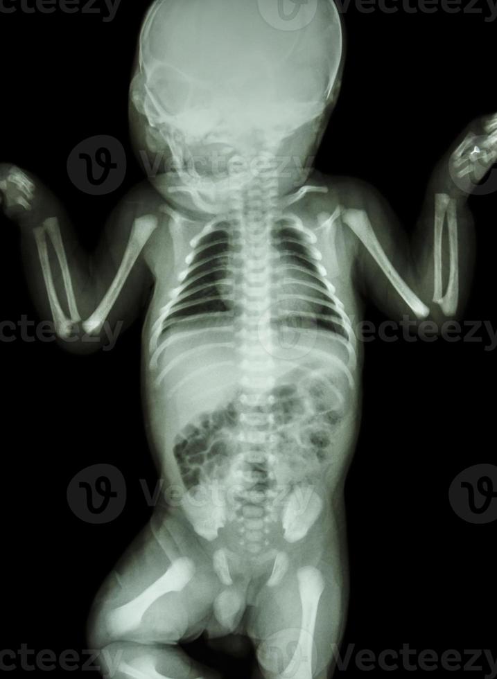 film x ray intero corpo del neonato foto
