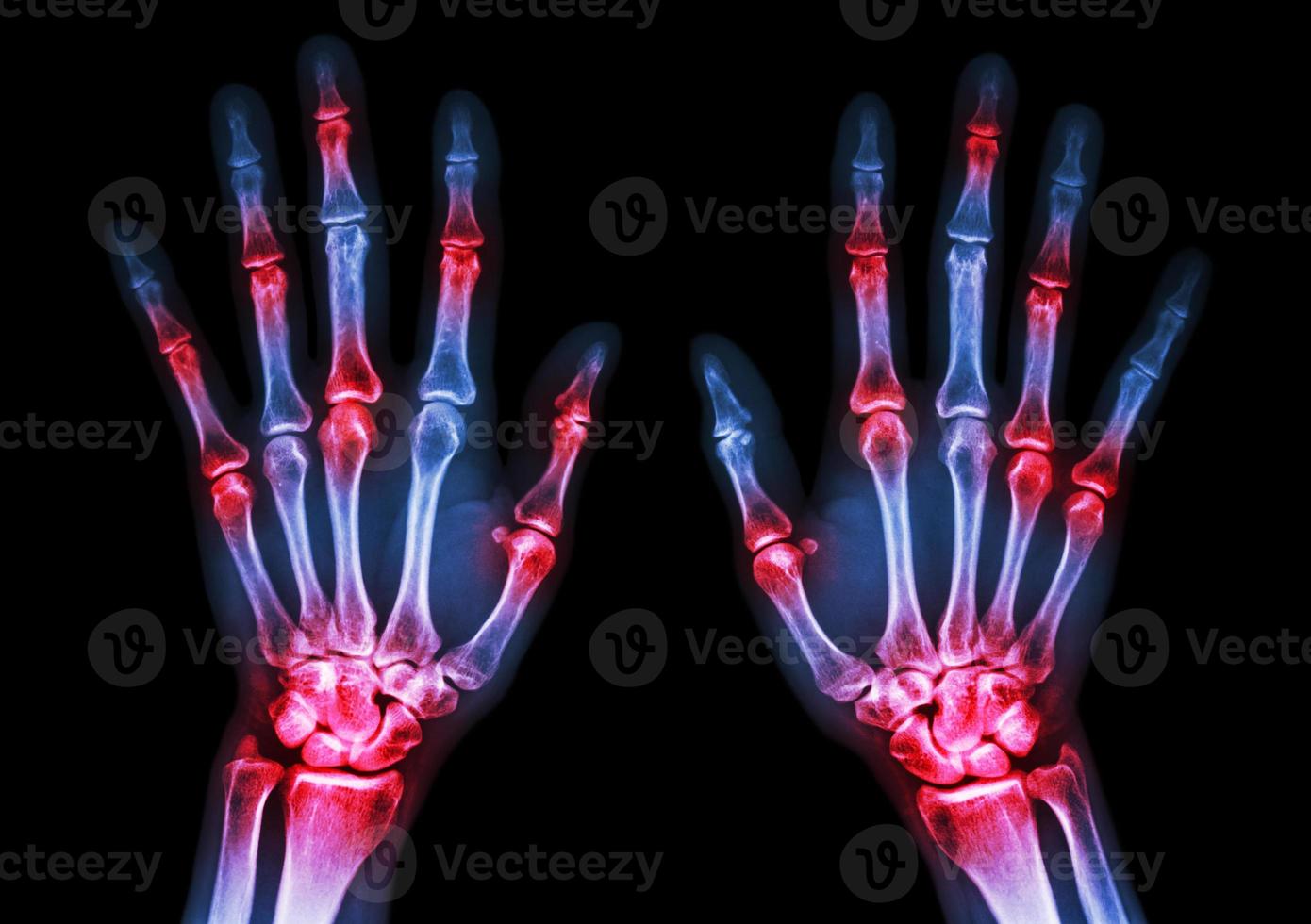film x ray entrambe le mani umane e artrite a più articolazioni gotta reumatoide foto