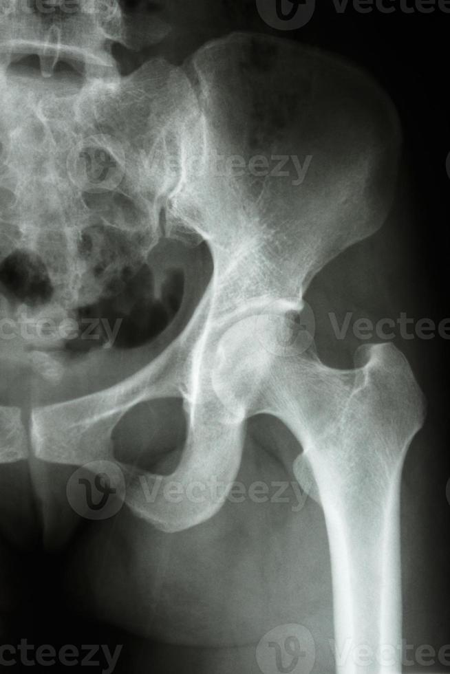 l'anca sinistra dei raggi x della pellicola mostra l'articolazione dell'anca umana normale foto