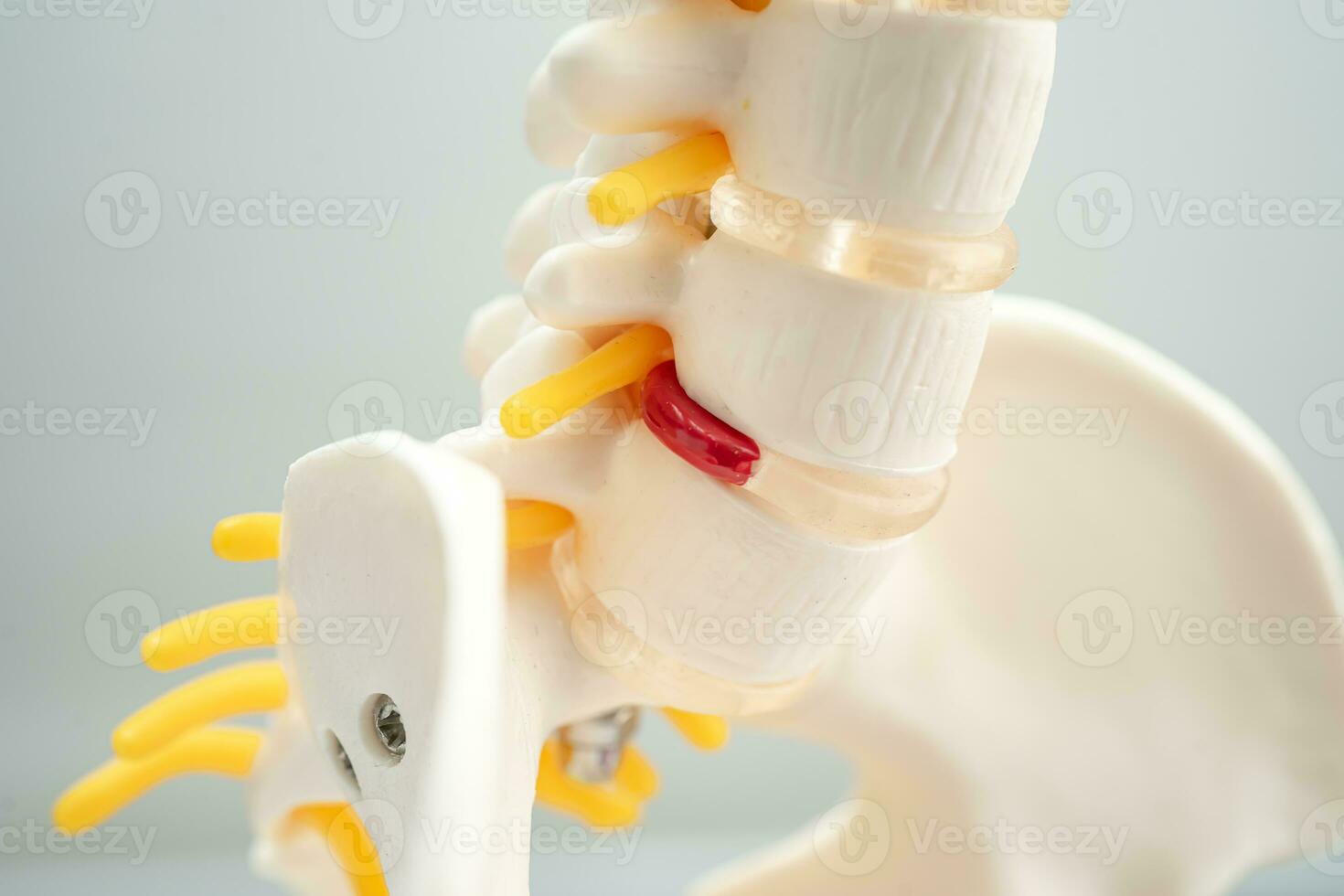lombare colonna vertebrale sfollati ernia disco frammento, spinale nervo e osso. modello per trattamento medico nel il ortopedico Dipartimento. foto