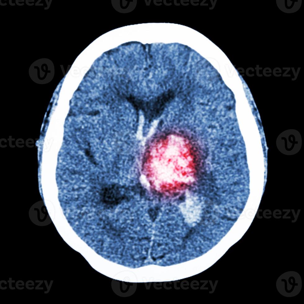 ct cervello mostra emorragia talamica sinistra ictus emorragico foto